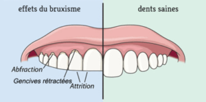 traitement du bruxisme par ostéopathie