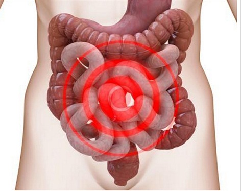 Syndrome de l'intestin irritable, colopathie fonctionnelle ...